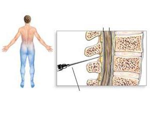 การระงับความรู้สึกเกี่ยวกับ epidural คือ