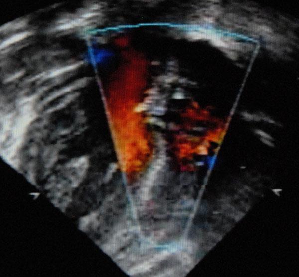 คอร์ดซ้ายของ ventricle เพิ่มเติม - มันคืออะไร?