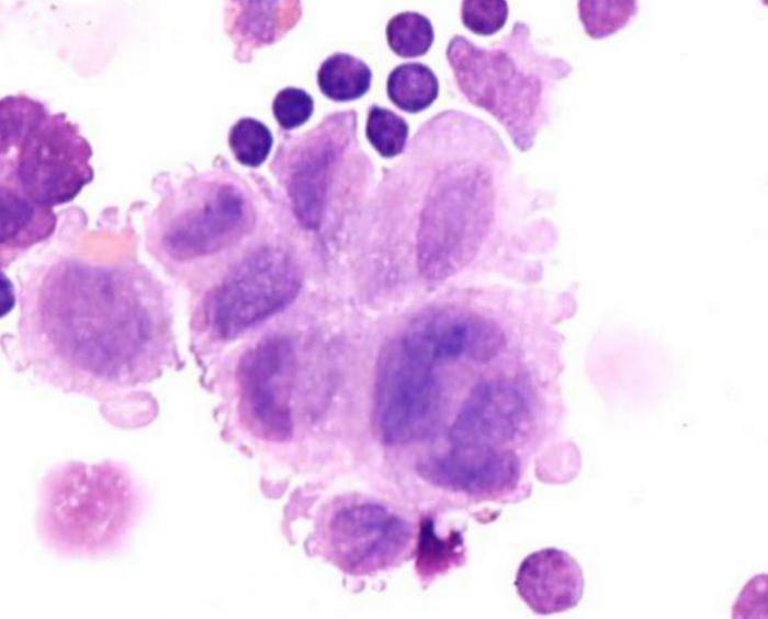 Hystiocytosis of Langerhans: สาเหตุและการรักษา