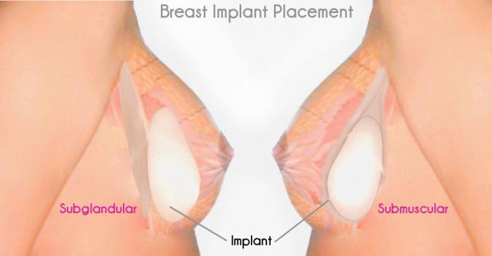 mammoplasty ก่อนและหลัง