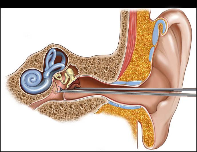 การผ่าตัดหูชั้นกลาง
